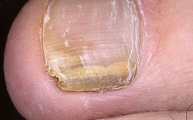 Manifestations of the mushroom on the thumb of the leg