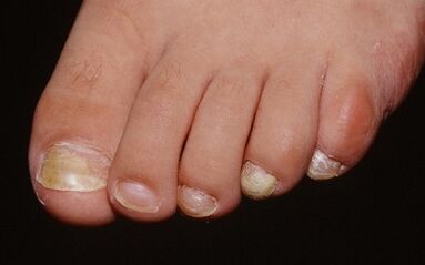 The reasons for the appearance of the mushroom on the thumb of the leg