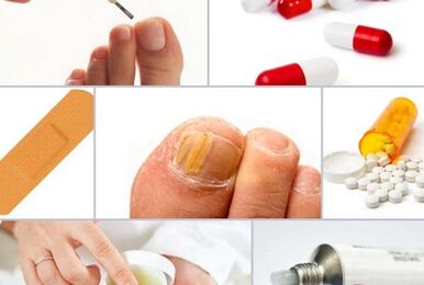 How to treat mushrooms on the nails
