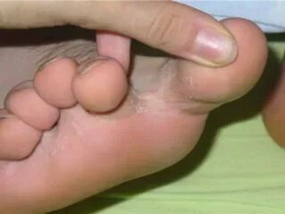 Itching the toes