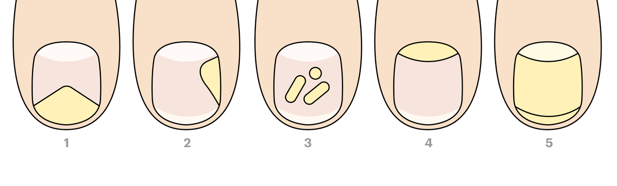 Types of Toenail Fungus
