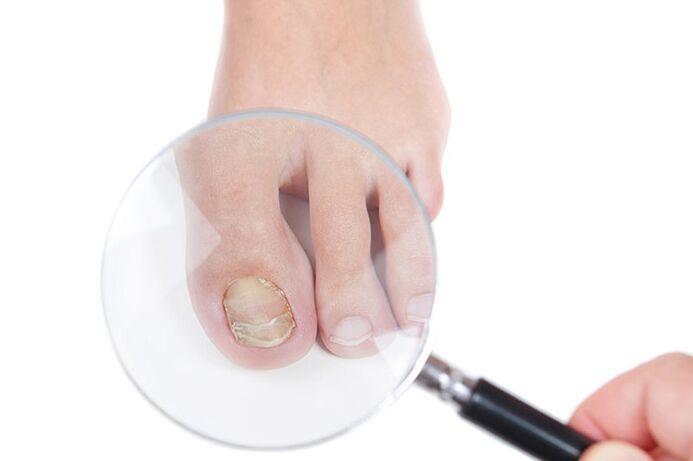 A nail affected by fungus under the magnifying glass