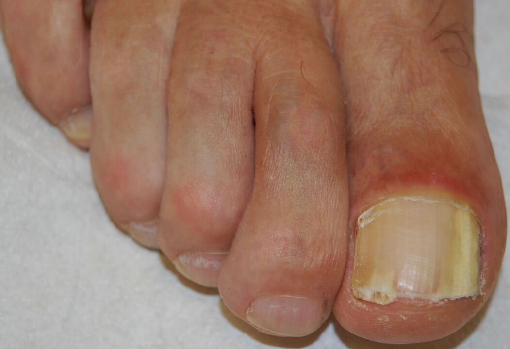 Distal lateral subungual onychomycosis of the leg